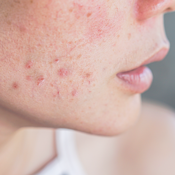 Post-Inflammatory Erythema vs Hyperpigmentation